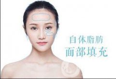 面部自體脂肪填充貴嗎？一般多少錢？