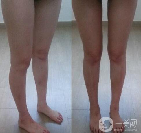 小腿吸脂價格,小腿吸脂真人*果反饋