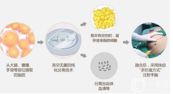 自體脂肪隆胸價(jià)格 自體脂肪豐胸后的危害