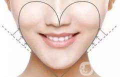 面部吸脂果圖 面部吸脂注意事項(xiàng)