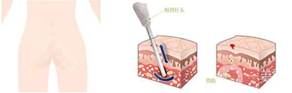 抽脂減肥價(jià)格一覽表 抽脂減肥有危害嗎