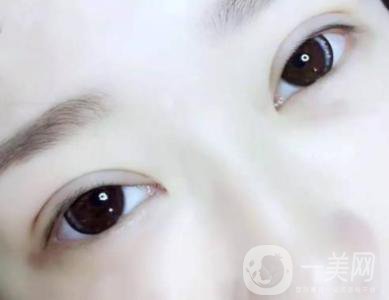 北京雙眼皮手術(shù)價(jià)格 雙眼皮手術(shù)多久消腫
