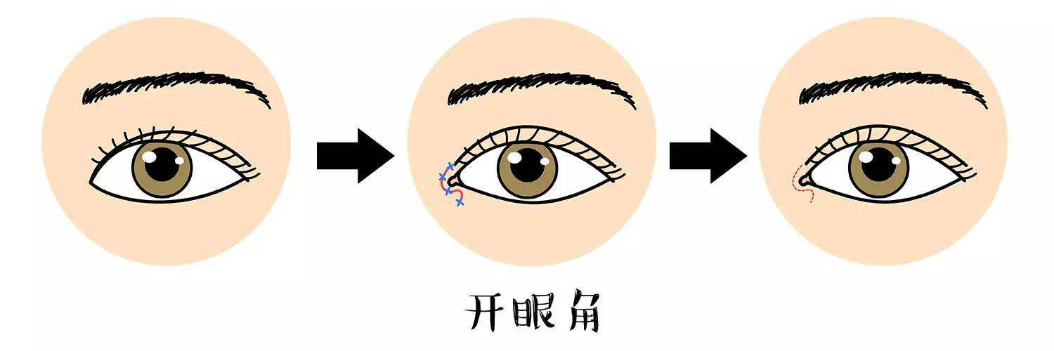 開眼角手術(shù)前后圖 開眼角注意事項(xiàng)