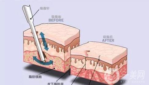 鐳射溶脂怎么樣 鐳射溶脂的功*是什么