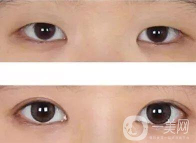 開眼角