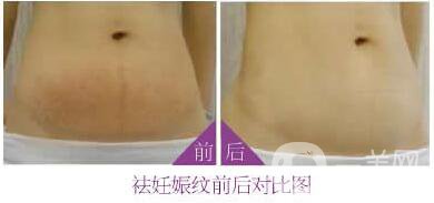 腹壁成形術(shù)風(fēng)險(xiǎn),腹壁成形術(shù)注意事項(xiàng)