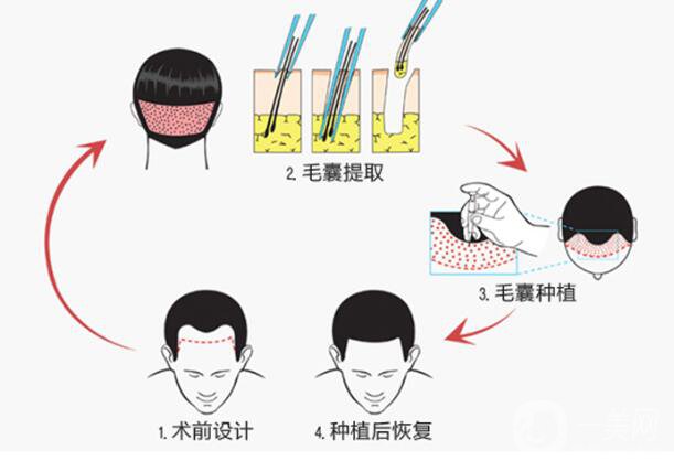 植發(fā)的*果是*性的嗎 它的原理是什么？