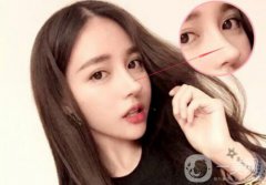 歪鼻矯正手術(shù)是怎樣的 手術(shù)方法有哪些？