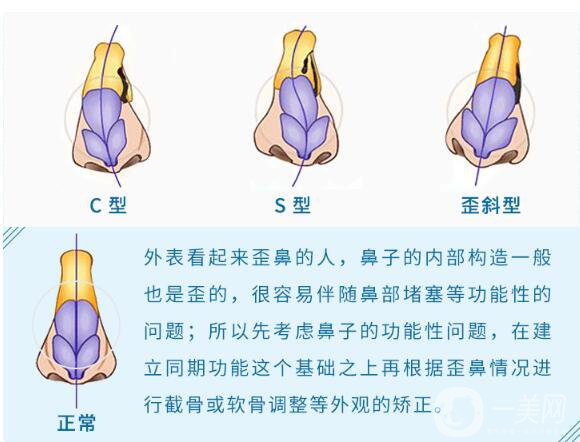 歪鼻矯正手術(shù)是怎樣的 手術(shù)方法有哪些？