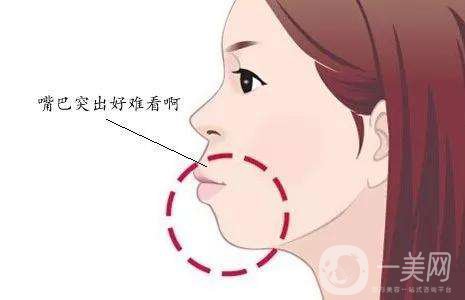 雙頜前突是什么 凸嘴不好看該怎么辦？
