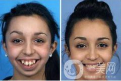 天包地矯正前后圖片：顏值變化不止一點(diǎn)點(diǎn)