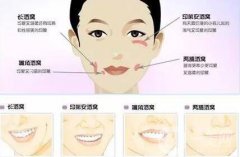 酒窩整形價(jià)格多少錢？多久恢復(fù)？