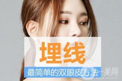 埋線雙眼皮果圖：不是人人都適合做埋線雙眼皮