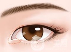 開眼角的果怎么樣 好不好？