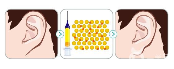 注射玻尿酸豐耳垂前后 豐耳垂*果好不好？