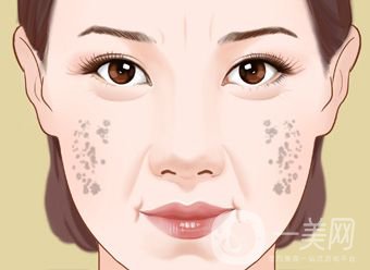 怎樣治老年斑 調節(jié)方法有哪些？