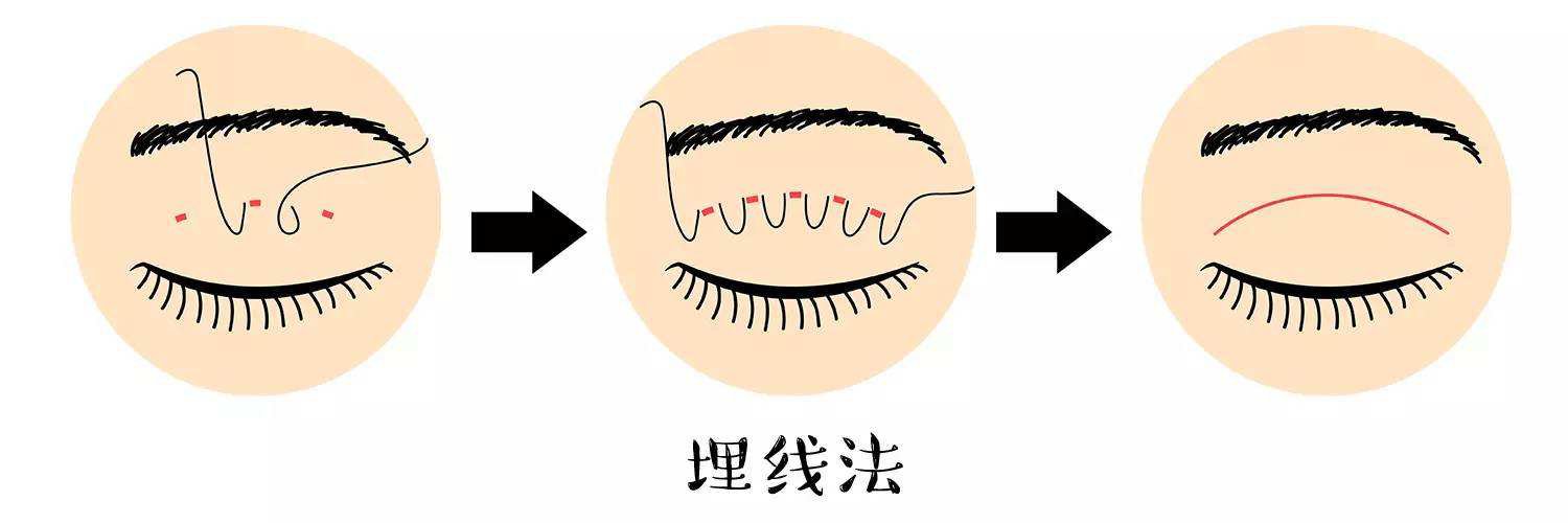 不開(kāi)刀的雙眼皮手術(shù)有哪些？