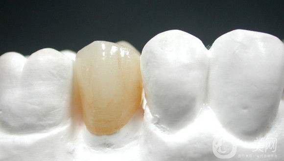烤瓷牙一般要多少錢 貴不貴？