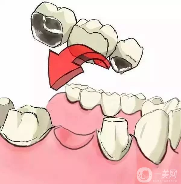 烤瓷牙一般要多少錢 貴不貴？