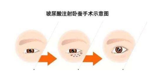 玻尿酸打臥蠶多久消腫 術后怎么護理好