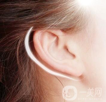 耳成形術(shù)是指什么 采用什么技術(shù)好