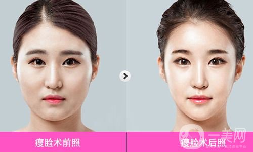 等離子溶脂價格 等離子溶脂瘦大腿可以嗎