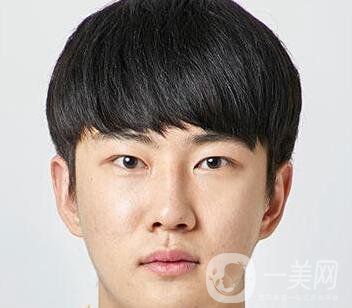 男人隆鼻前后附照片 隆鼻*果好嗎？