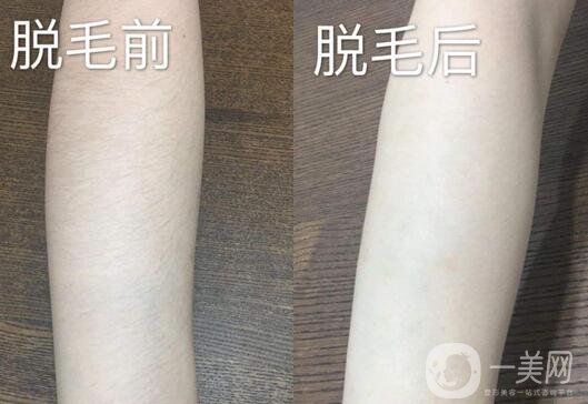 激光脫毛詳細(xì)介紹 激光脫毛有哪些優(yōu)缺點(diǎn)？