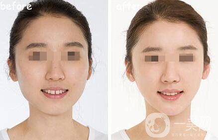 　　什么是短下巴手術(shù)?如果前下巴下陷，就用手術(shù)切下巴，把下巴向前移動(dòng)。這種定制的手術(shù)使下巴向前移動(dòng)，通過諸如前進(jìn)、T截骨和假體插入等步驟，使面部線條自然而美觀，這取決于個(gè)人的下巴狀況。短下巴手術(shù)，以移動(dòng)下巴尖向前，糾正不明確的下巴線，并改良你的臉，如果你的牙齒遮擋是好的，盡管你的下陷下巴。  什么是短下巴手術(shù) 短下巴手術(shù)類型  　　短下巴手術(shù)認(rèn)為是一個(gè)短下巴(微頜)，如果下巴是下陷，牙合是差的。它可以通過雙頜截骨術(shù)(雙頜手術(shù))矯正，使整個(gè)下巴向前移動(dòng)。  　　雙頜截骨術(shù)(雙頜手術(shù))的捷徑骨刀提高準(zhǔn)確性，骨手術(shù)刀是一種超聲波裝置，它只對(duì)骨組織起反應(yīng)作用，從而切割骨骼。它有較小的振動(dòng)在0.5mm內(nèi)，使一個(gè)**的手術(shù)，保護(hù)附近的血管和神經(jīng)，只對(duì)骨骼作出反應(yīng)，造成較少的組織損傷和出血，并提供*。    　　這些人需要做短下巴手術(shù)：  　　1、如果你的下顎凹陷了  　　2、如果你的下顎很小  　　3、如果你有突出的上牙  　　4、如果你的下巴和脖子有一個(gè)不清楚的界限  　　5、如果你看起來像下巴上有很多脂肪，下巴很短，就會(huì)有皺紋。  　　6、如果你經(jīng)常聽到你看起來很遲鈍  　　短下巴手術(shù)類型  　　1、前下巴(下巴尖)前進(jìn)。這個(gè)過程把下陷的骨頭切成向前移動(dòng)的長度。根據(jù)骨切除的角度調(diào)整下巴的長度，形成一條自然的下頜線。  　　2、把下陷的骨頭往前移。這一過程減少和糾正了下巴的寬度，使下巴線條更苗條、更漂亮。  　　3、集骨。收集切割的骨頭并向前移動(dòng)。  　　4、刮去骨頭。平滑地研磨下巴線。  　　5、假體插入。這個(gè)過程通過口腔的一個(gè)小切口將塑造成下巴骨輪廓的假體插入到下巴骨的前側(cè)。