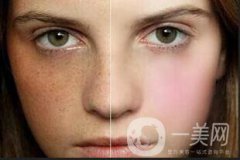 皮膚斑點：老年斑、鼴鼠、黃褐斑和雀斑的區(qū)別