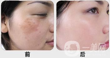 白瓷娃娃做完多久*果？幾次*果？