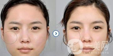 改變臉型手術(shù)要多少錢呢？