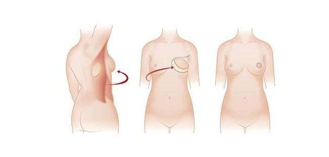 北京乳房再造術(shù)多少錢?*果維持多久？