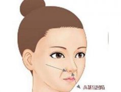 墊鼻基底有什么后遺癥?術(shù)后怎么護(hù)理?