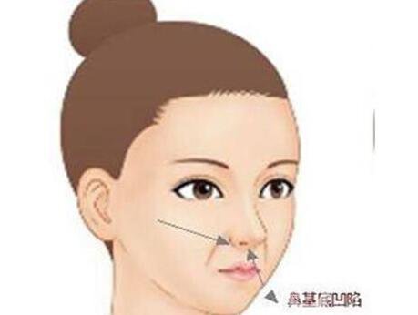 墊鼻基底后遺癥,墊鼻基底術(shù)后護(hù)理