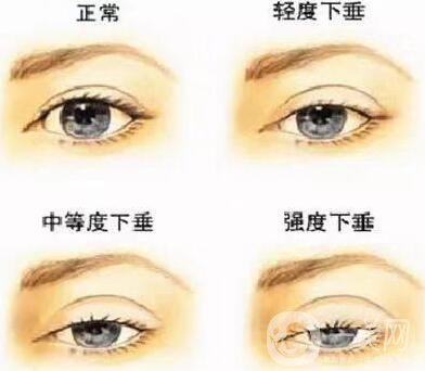 重瞼去皮