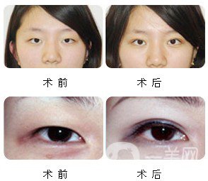 割雙眼皮多久恢復(fù)自然？
