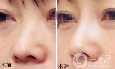 膨體隆鼻是終生的嗎？