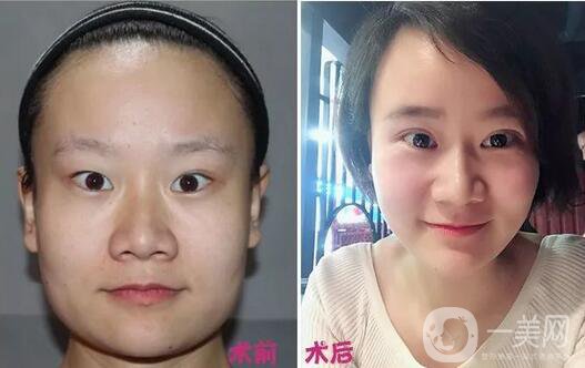 上眼皮吸脂價格,雙眼皮