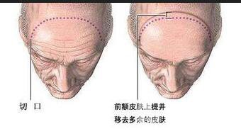 去除抬頭紋風險,去除抬頭紋方法