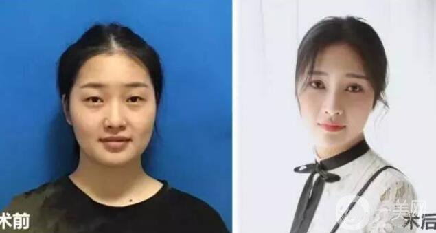 開眼角疼嗎？這幾種情況開眼角*果堪比換頭！