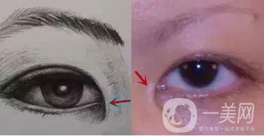 開眼角疼嗎？這幾種情況開眼角*果堪比換頭！