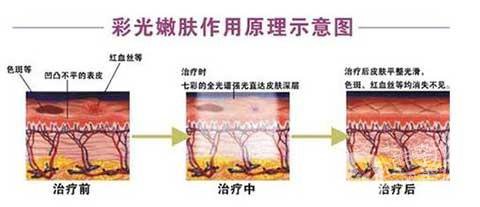 彩光嫩膚好嗎？*果如何？