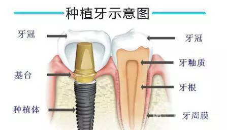 人工種植牙齒價(jià)格 手術(shù)費(fèi)用多少錢？