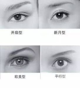 全切雙眼皮多久自然 手術有年齡限制嗎？