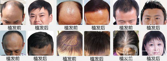 植發(fā)費(fèi)用多少錢(qián) 價(jià)格高不高？