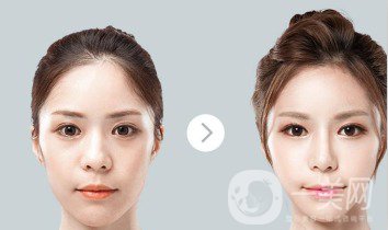 自體肋軟骨隆鼻危害有哪些？隆鼻價(jià)格