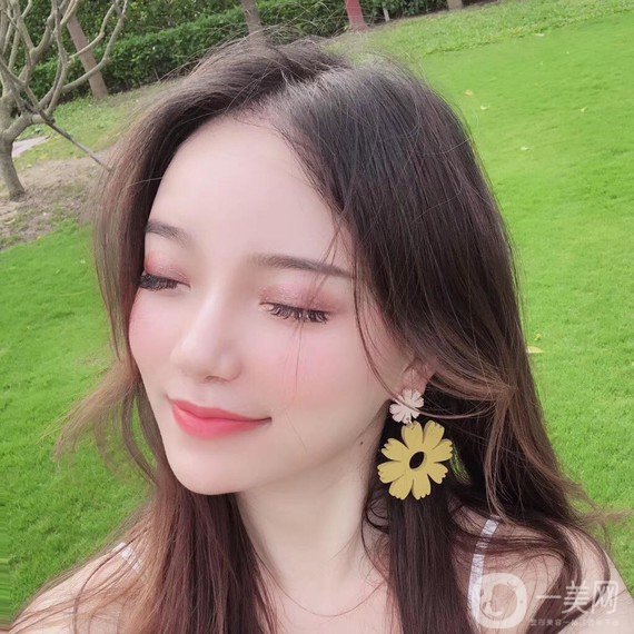 植發(fā)半年后案例 植發(fā)怎么樣？