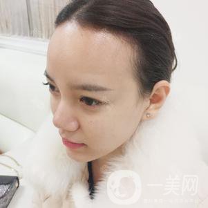 植發(fā)半年后案例 植發(fā)怎么樣？