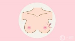 什么是倒置乳頭 倒置乳頭矯正操作方法